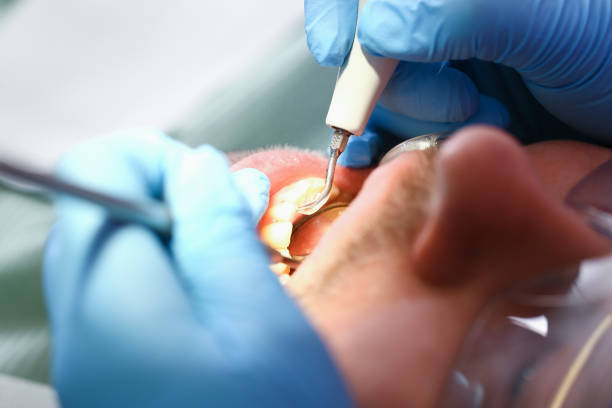 Best Emergency Wisdom Tooth Extraction in La Presa, CA