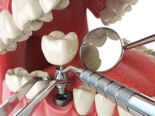 Best Emergency Cosmetic Dentistry (e.g., broken veneers) in La Presa, CA